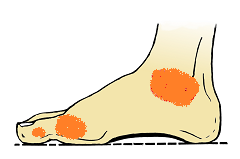 Fuß Arthritis