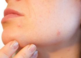 Atopische Dermatitis: EU-Zulassung für Rinvoq