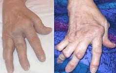 Gesunder Lebensstil senkt Risiko für rheumatoide Arthritis